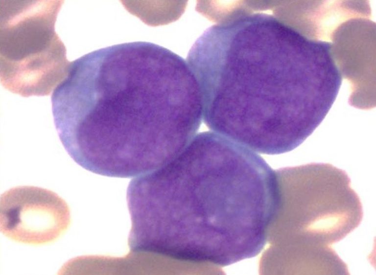 Cup-like blasts with nuclear invagination in AML with the FLT3-ITD mutation