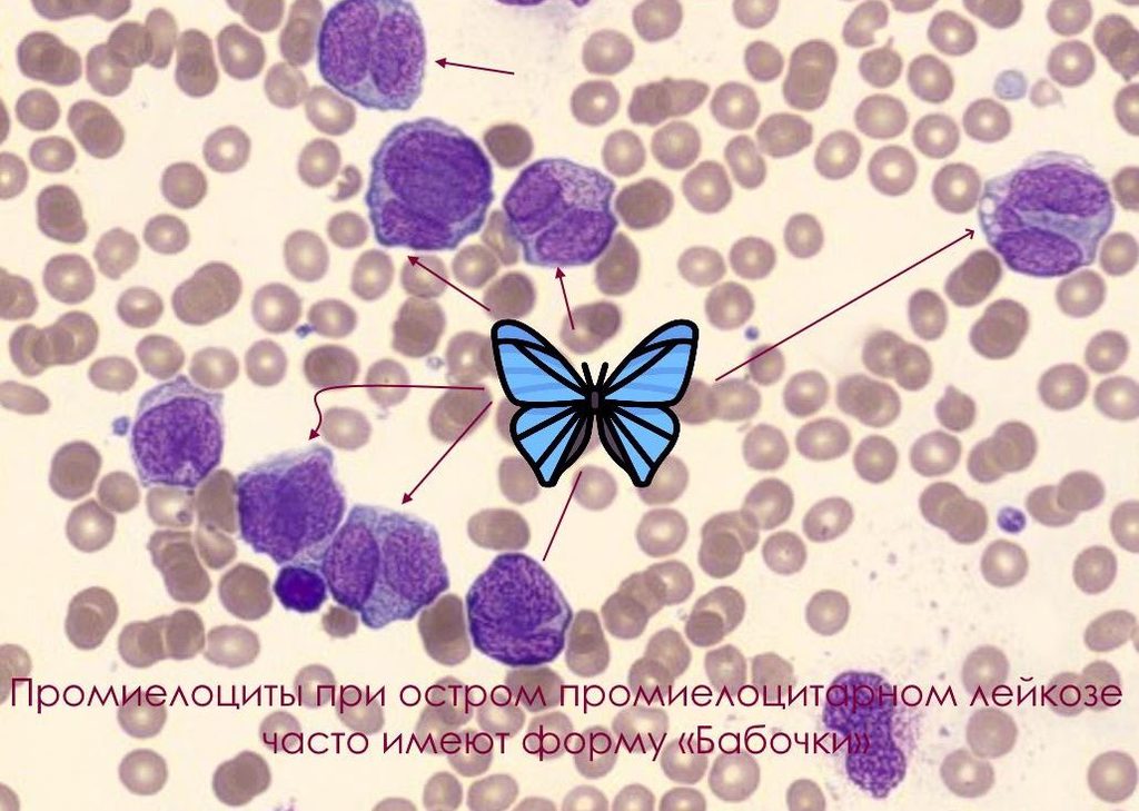 «Butterfly wing» promyelocytes in acute promyelocytic leukaemia