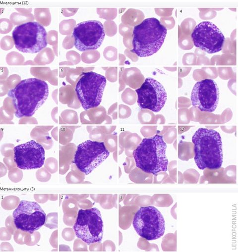 Myelocytes and metamyelocytes in chronic myeloid leukaemia
