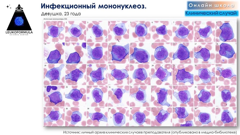 Reactive lymphocytes in a 23-year-old woman