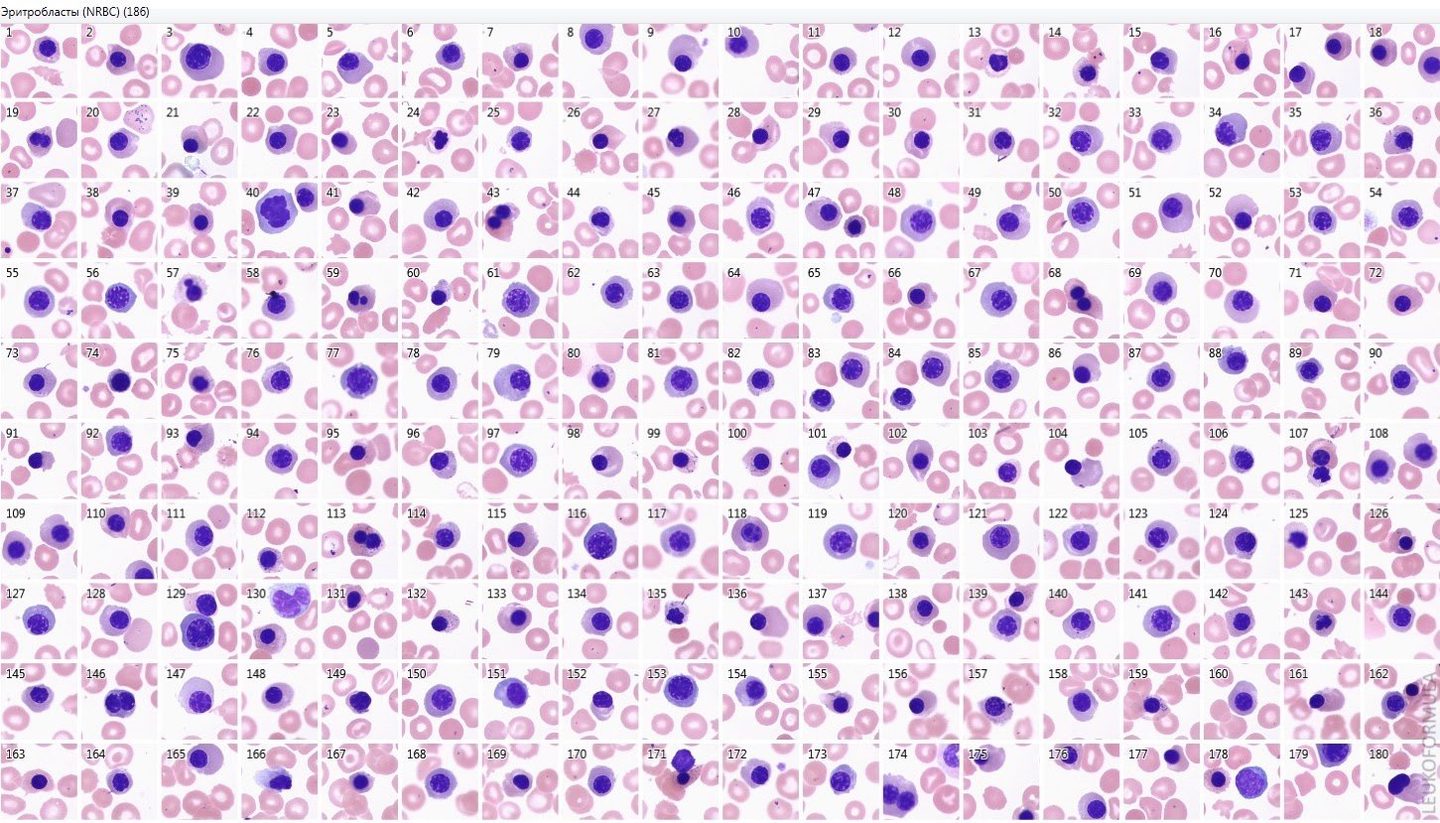 Normoblasts in the peripheral blood