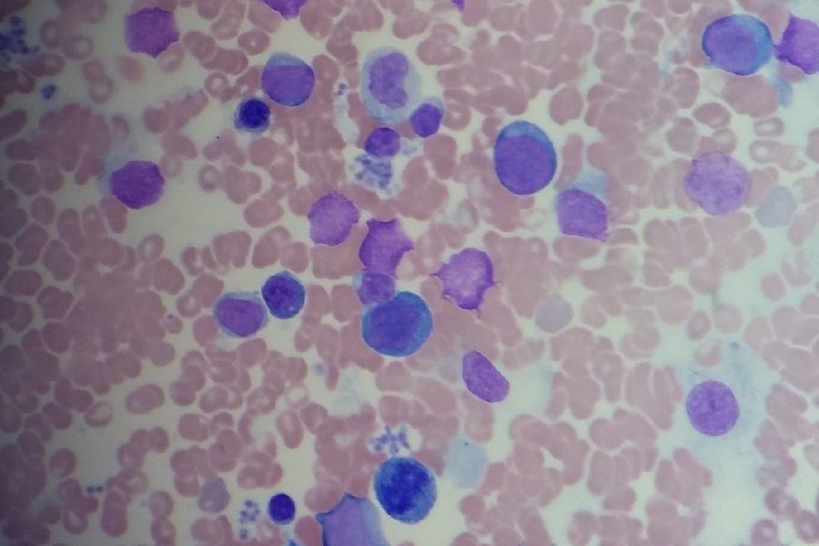 Agranulocytosis: Myelogram in Granulopoiesis Reduction