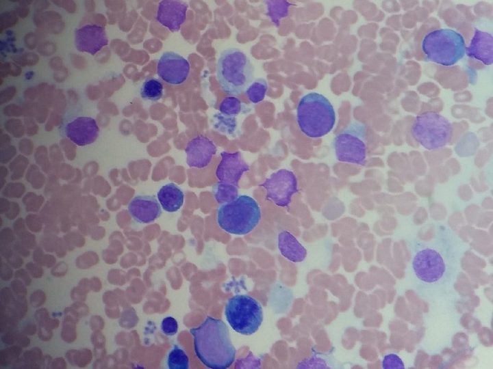 Bone marrow smear: absence of mature granulocytes, plasma cells, and erythroid cells