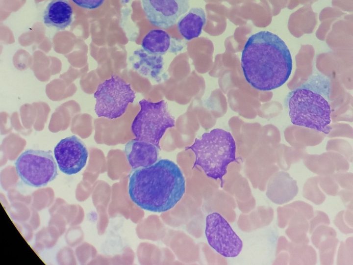 Bone marrow smear: plasma cells and mononuclear cells in severe agranulocytosis