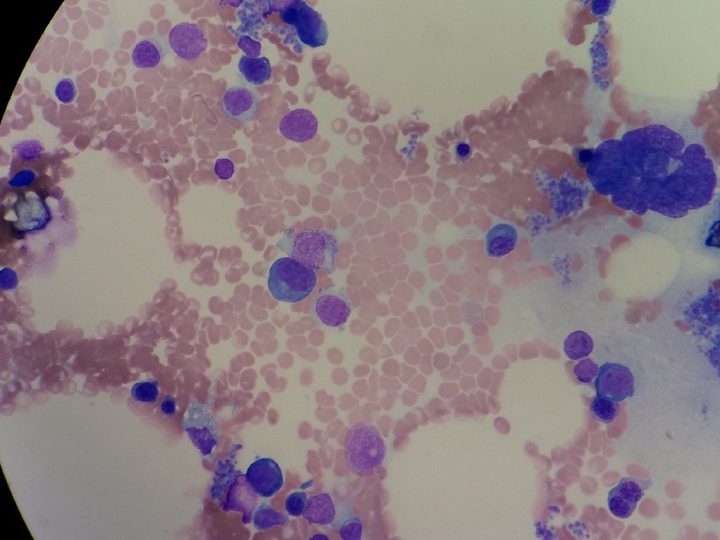 Bone marrow smear: myeloid hypoplasia and preserved mature megakaryocyte