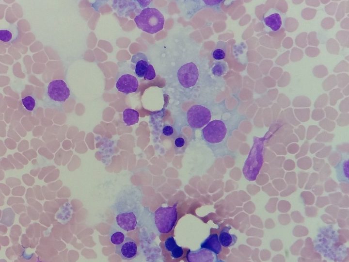 Bone marrow smear: fat droplets, single precursors, and reactive lymphocytes