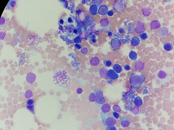 Bone marrow smear: predominance of erythroblasts and plasma cells in conditions of myelopoiesis aplasia