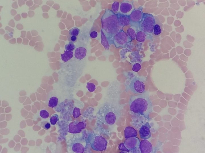 Bone marrow smear: pronounced reduction of granulocytic lineage with abundant plasma cells
