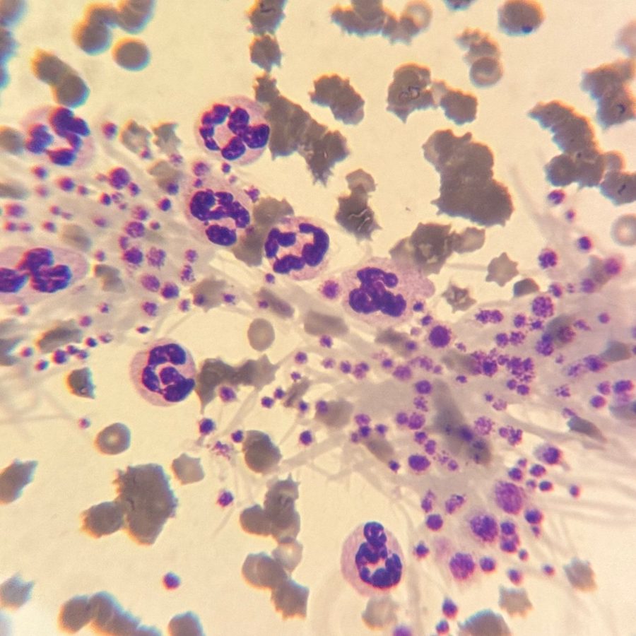 Platelet Aggregation & Fibrin Strands in Blood Smear