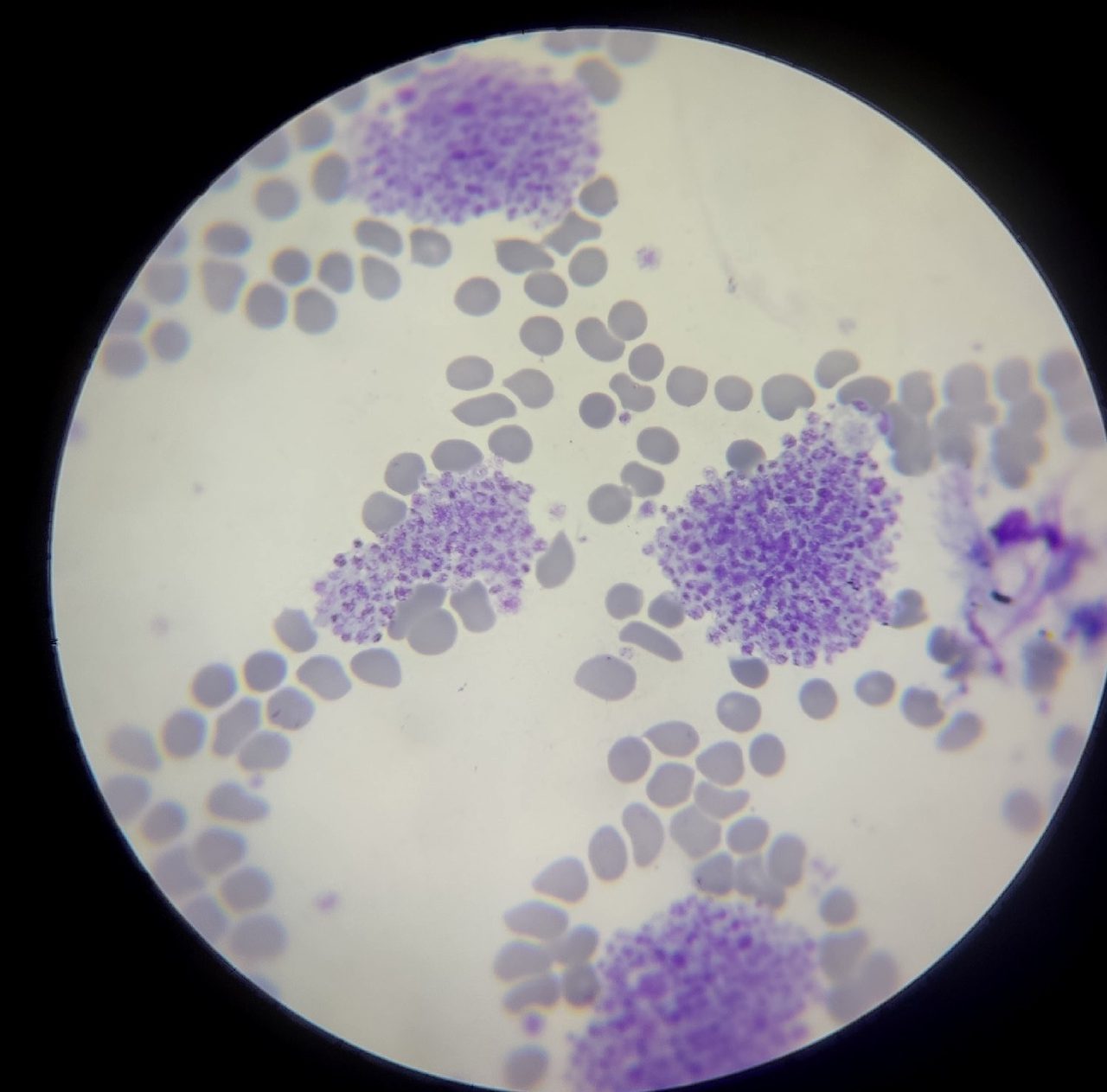 Blood smear: large aggregates of platelets among red blood cells