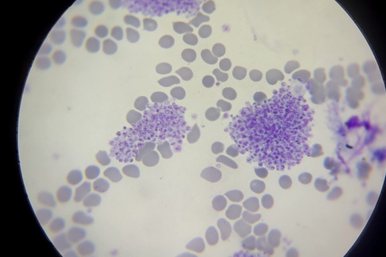 Platelet Aggregation as a Cause of Pseudothrombocytopenia