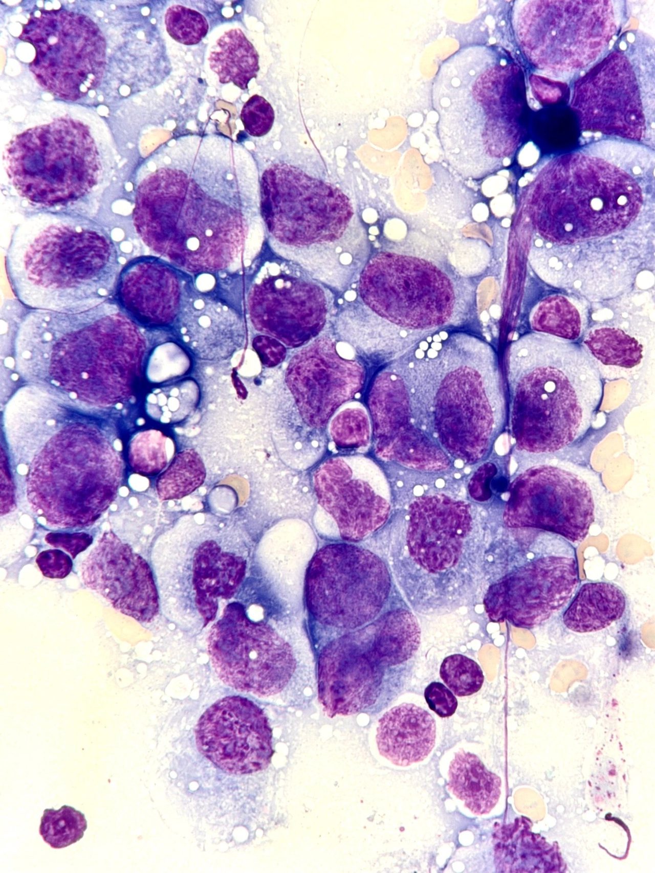 ALK-Positive Anaplastic Large Cell Lymphoma: Cytology