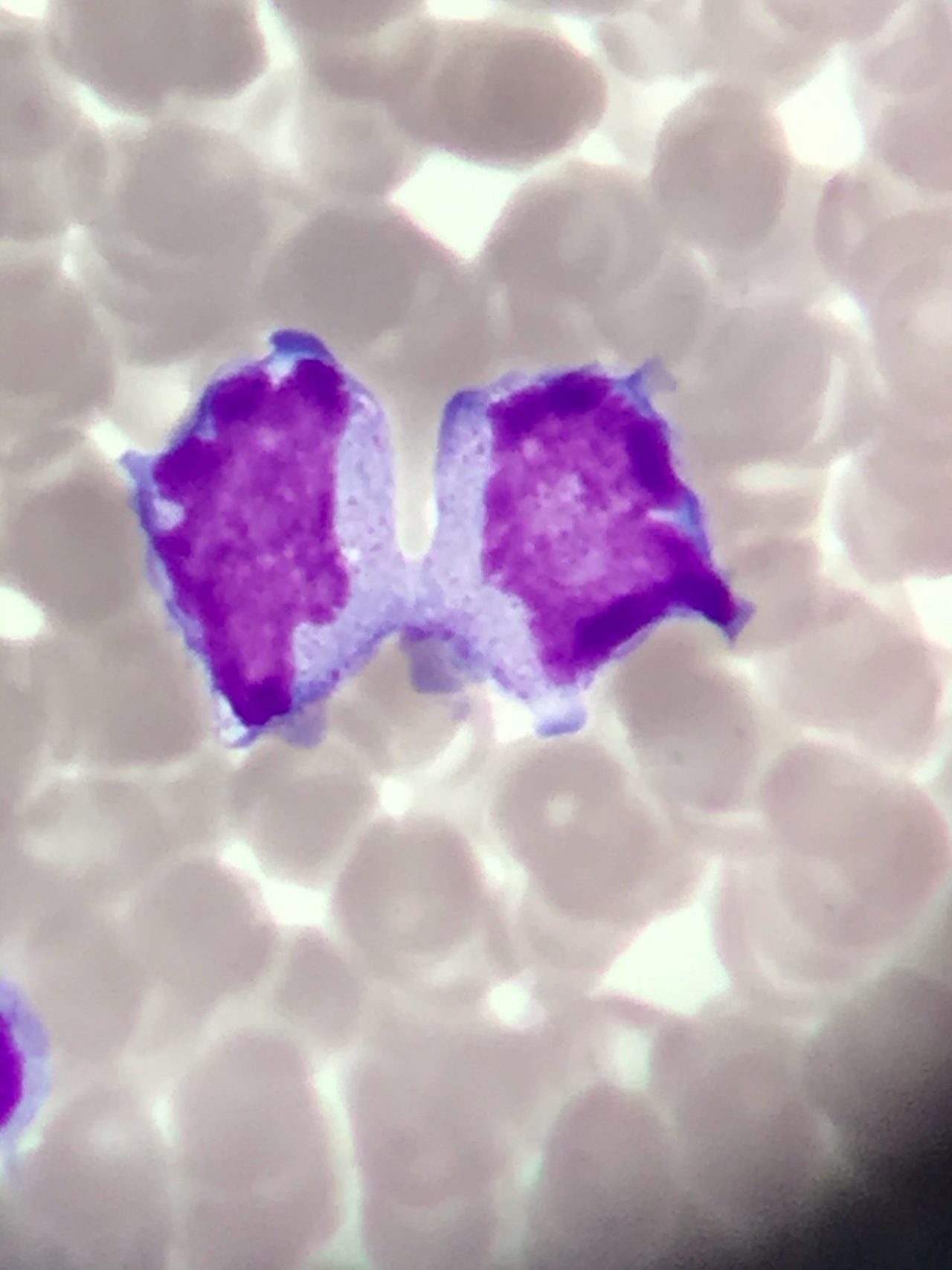Amitosis in Bone Marrow Smear: Morphological Features