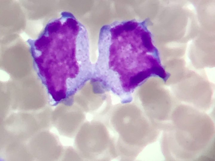 Bone marrow smear, close-up of a cell with signs of amitosis