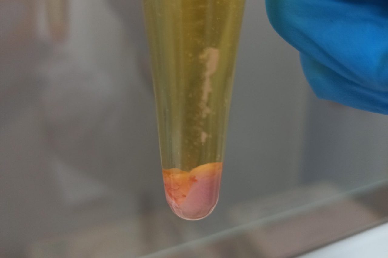 Amorphous Urates in Urine Sediment: Laboratory Diagnostics