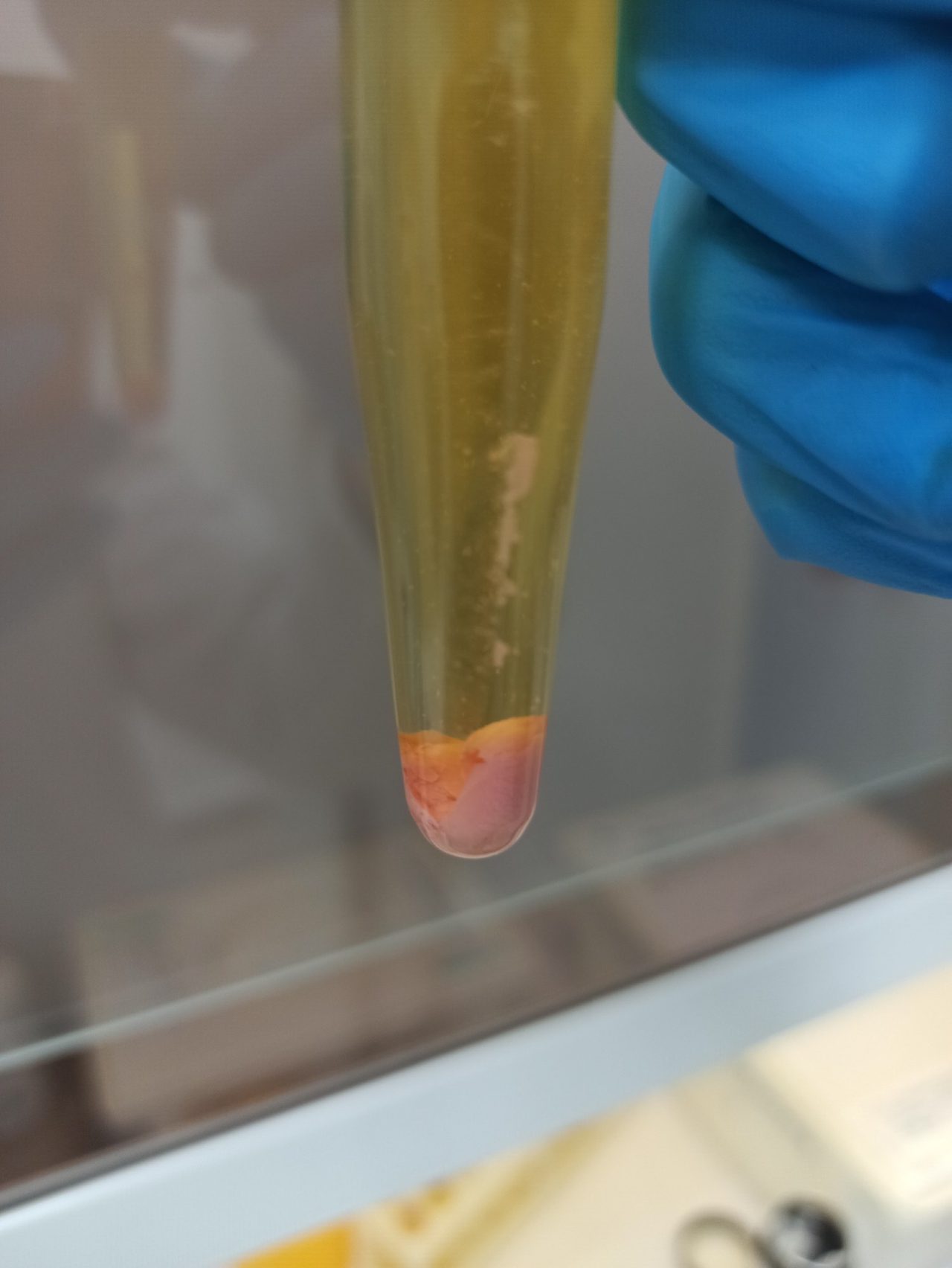 Amorphous Urates in Urine Sediment: Laboratory Diagnostics