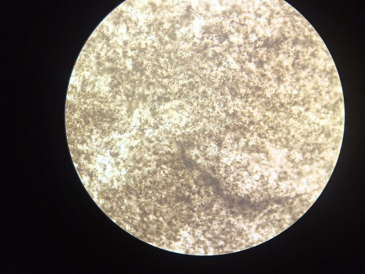 Native preparation of urine sediment: amorphous urates completely filling the field of view
