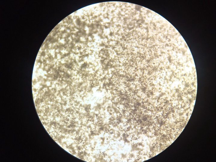 Native preparation: massive accumulations of amorphous urate granules