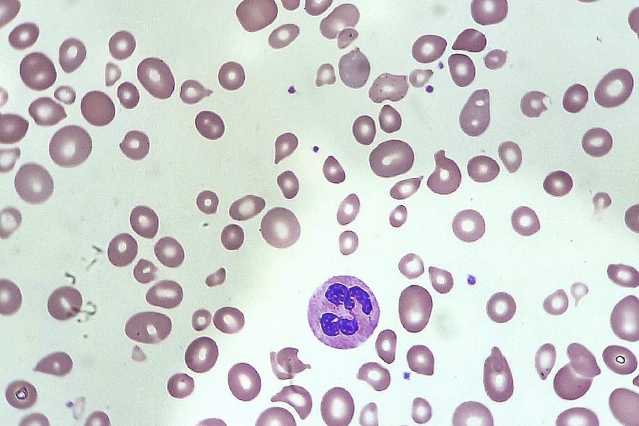 Fanconi Anemia in an Adult: Blood Smear Morphology