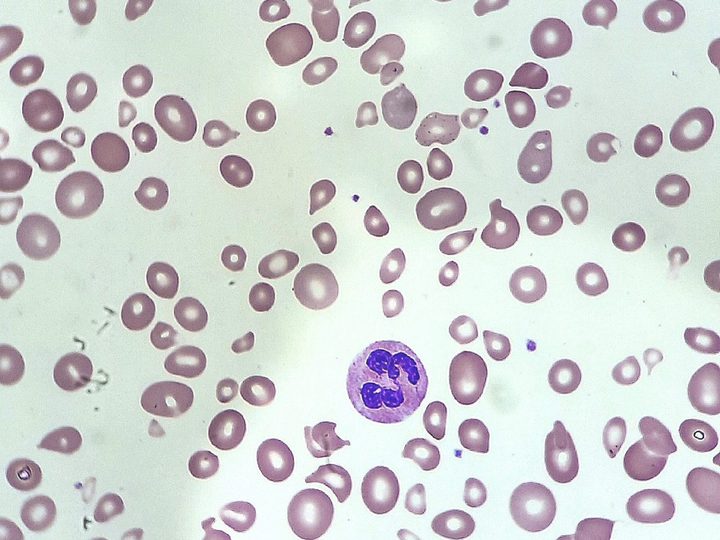 Blood smear: hypersegmented neutrophil and polymorphic erythrocytes
