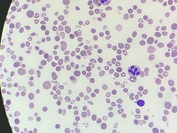 Blood smear: general view with marked anisopoikilocytosis and a lymphocyte