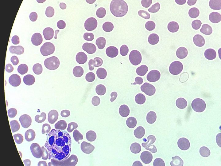 Blood smear: hypersegmented neutrophil with abundant nuclear segments