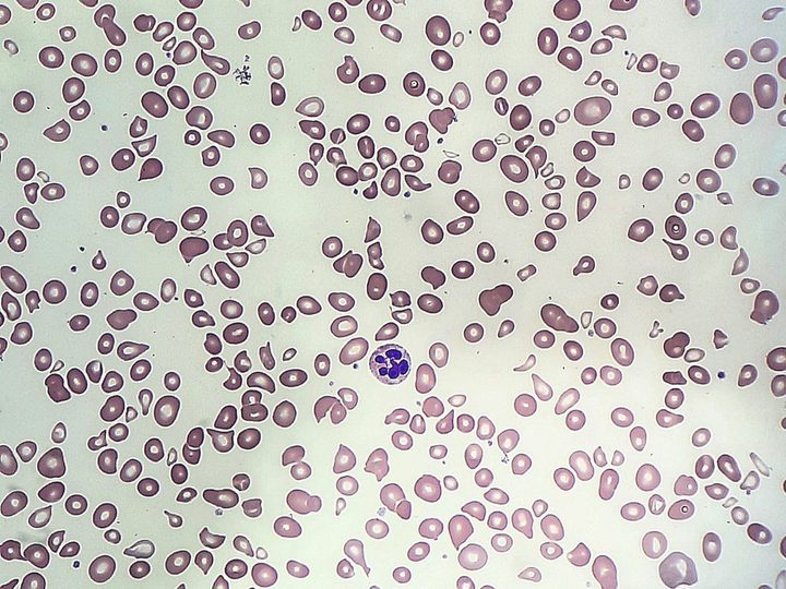 Blood smear: marked poikilocytosis, dacryocytes, and a hypersegmented neutrophil