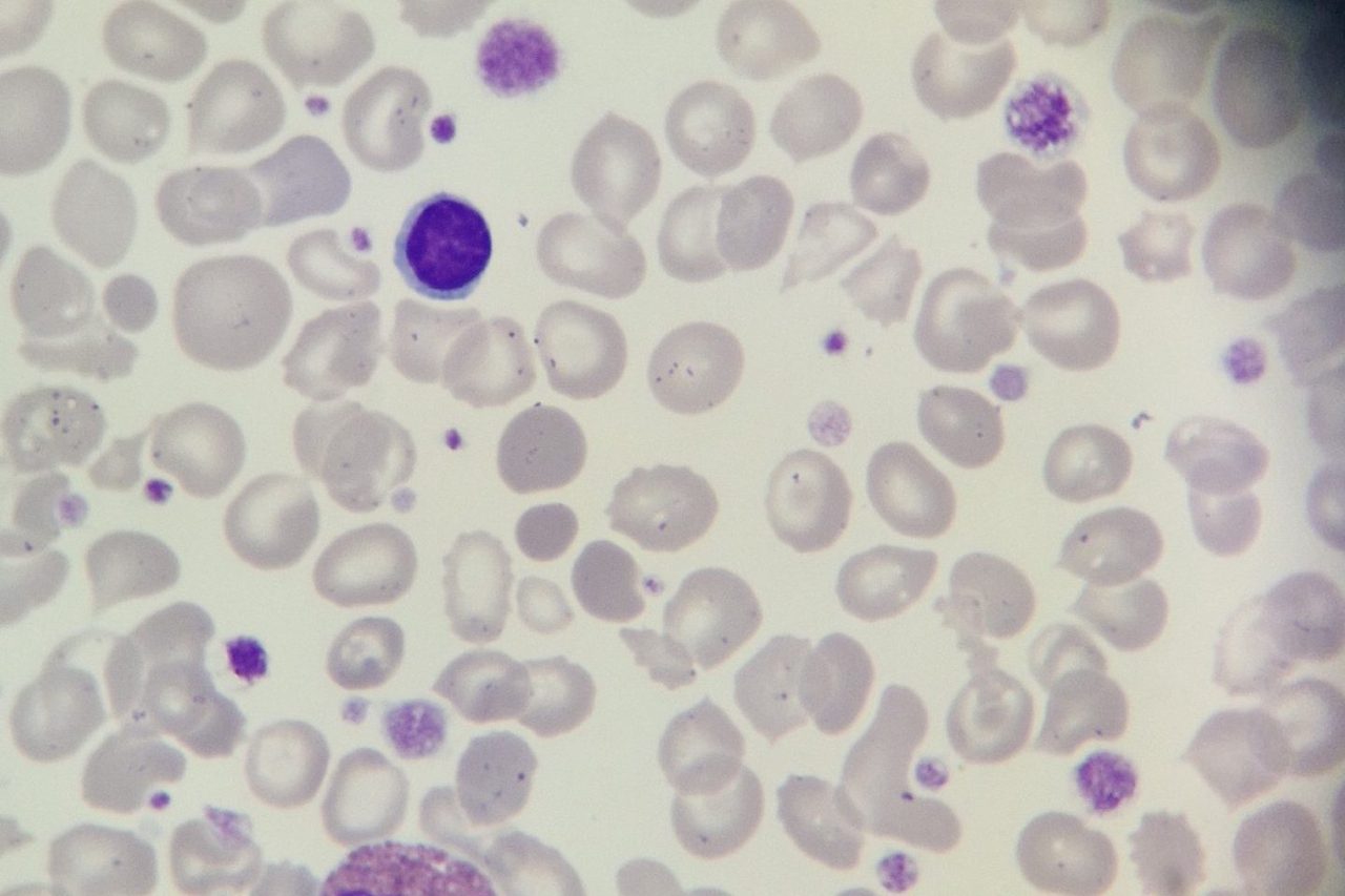 Anisocytosis of Platelets and Erythrocytes in Myelofibrosis