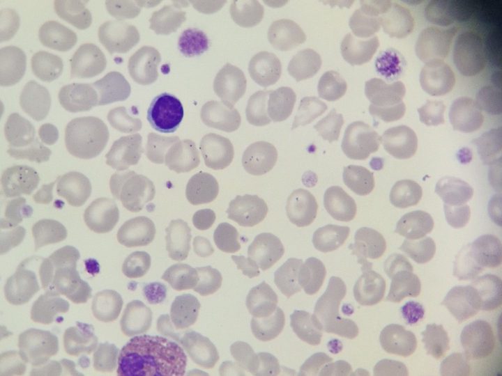 Blood smear: giant platelets, erythrocyte anisopoikilocytosis in myelofibrosis