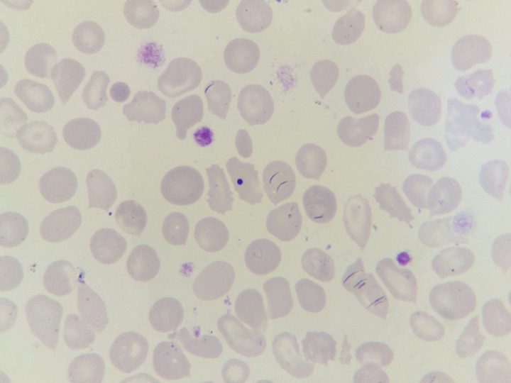 Blood smear: dacryocytes, Howell-Jolly body, and large platelets in myelofibrosis