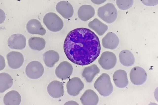 Atypical Monocyte Morphology in Peripheral Blood Smear