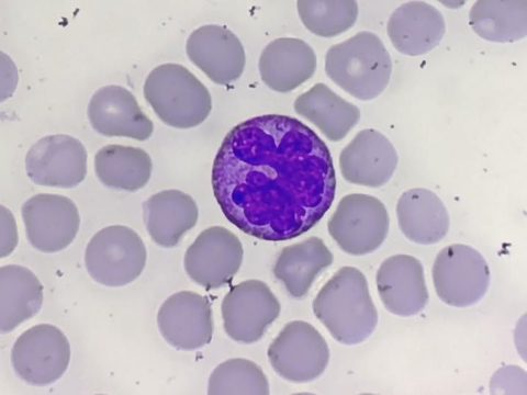 Blood smear: monocyte with bizarre nuclear shape