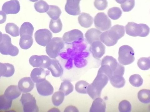 Blood smear: monocyte with multi-lobed bizarre nucleus