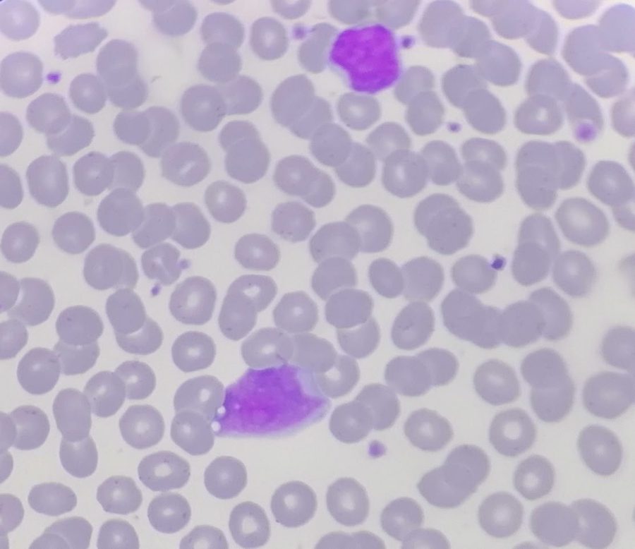 Atypical Lymphocytes in Lymphoma: Blood and Bone Marrow