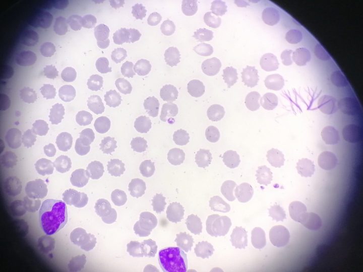 Blood smear: atypical lymphoid cells with irregular nuclear contours