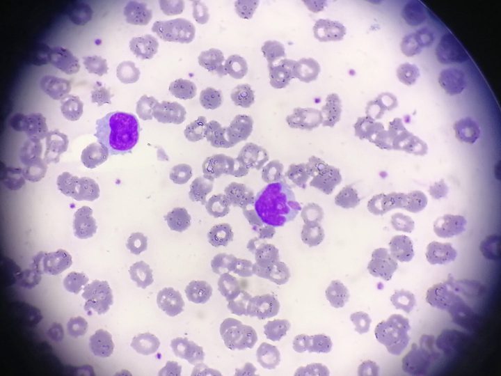 Blood smear: lymphoid cells with notched nuclei and chromatin condensation