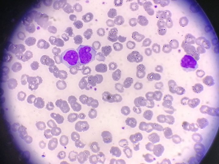 Blood smear: two atypical lymphocytes with deep nuclear invaginations and nucleoli
