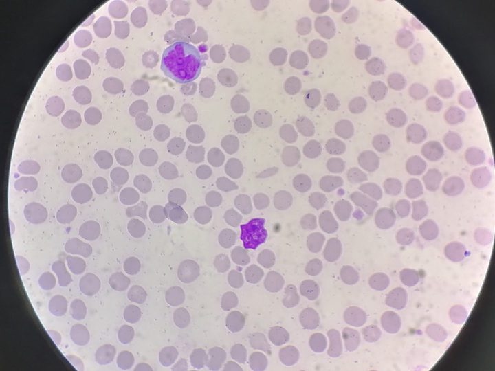 Blood smear: polymorphic lymphoid cells with irregularly shaped nuclei