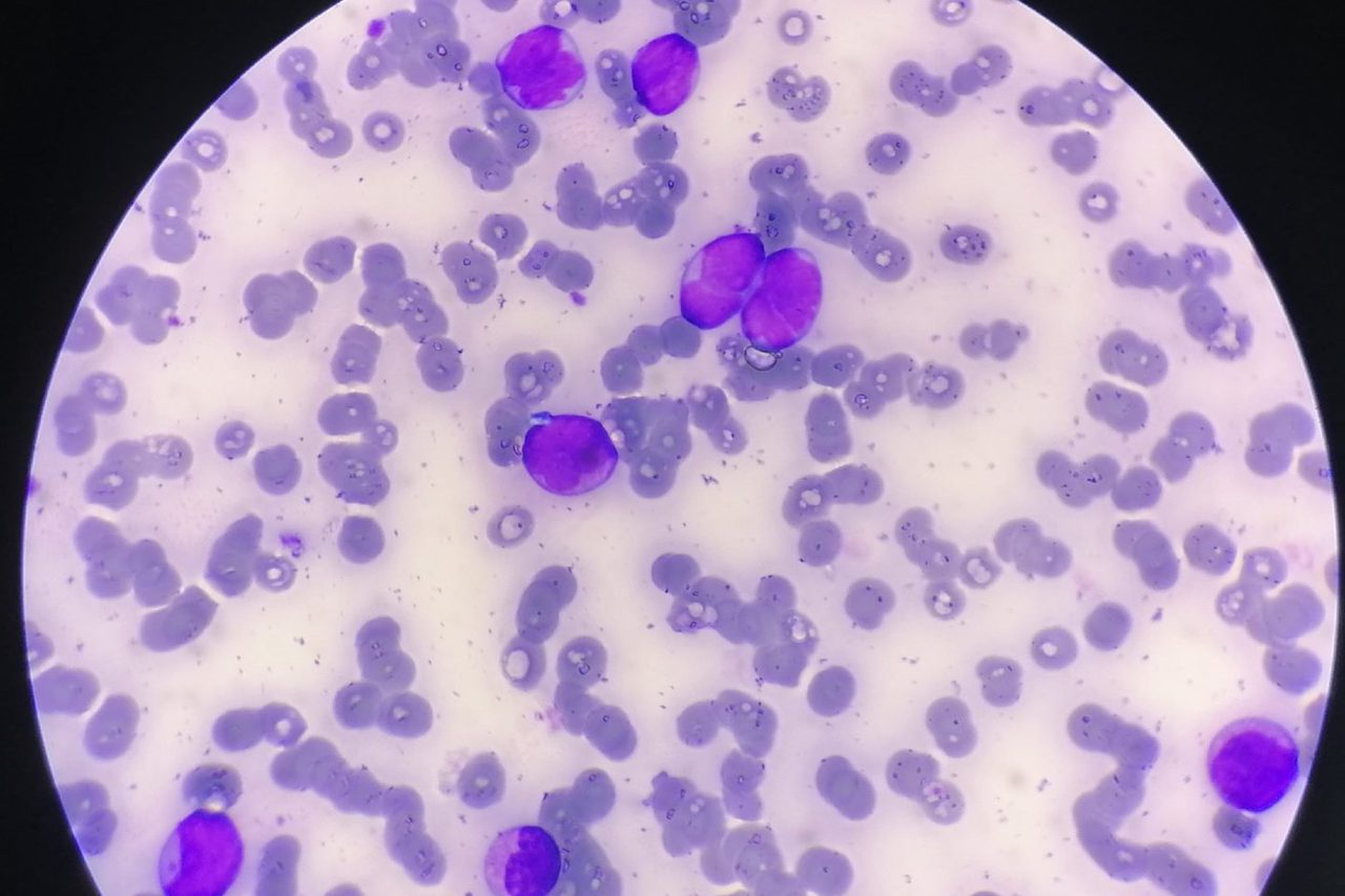 Atypical Lymphoid Cells in Lymphoma Leukemization