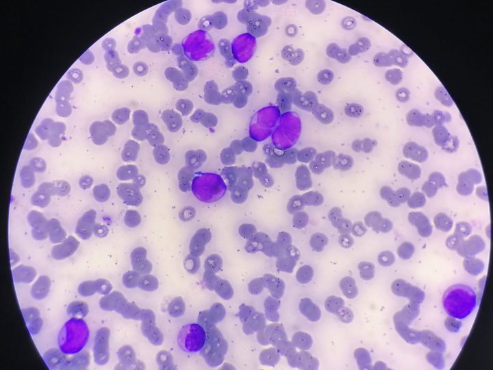 Blood smear: atypical lymphoid cells with nuclear polymorphism