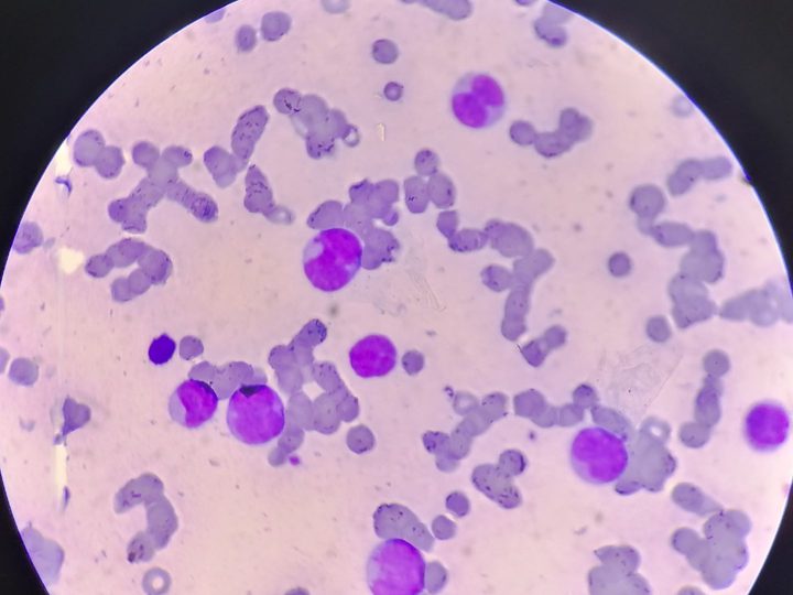 Blood smear: atypical lymphocytes with suspected leukemization