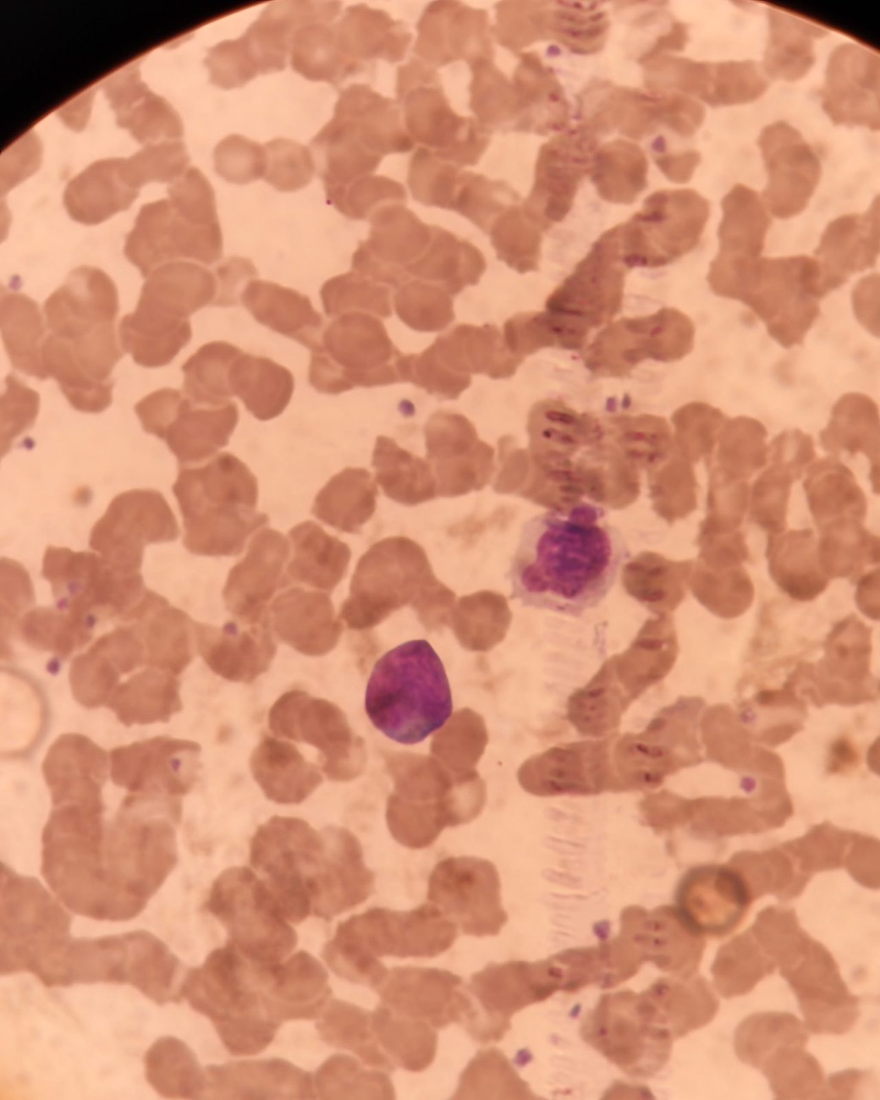Атипичные лимфоидные клетки в периферической крови