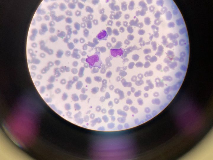 Blood smear: atypical mononuclear cells with basophilic cytoplasm