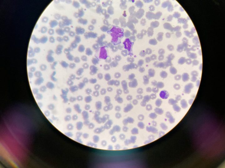Blood smear: reactive lymphocytes flowing around adjacent red blood cells
