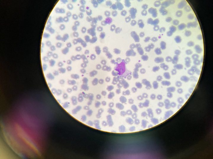Blood smear: large atypical mononuclear cell in the center of the field of view