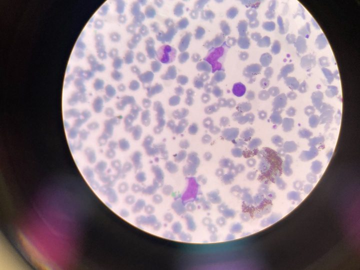Blood smear: broad-cytoplasm mononuclear cell and mature neutrophil