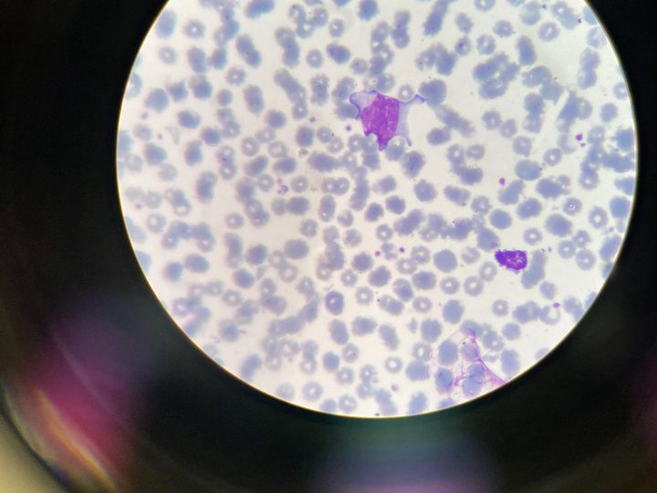 Blood smear: activated lymphocyte with abundant polymorphic cytoplasm