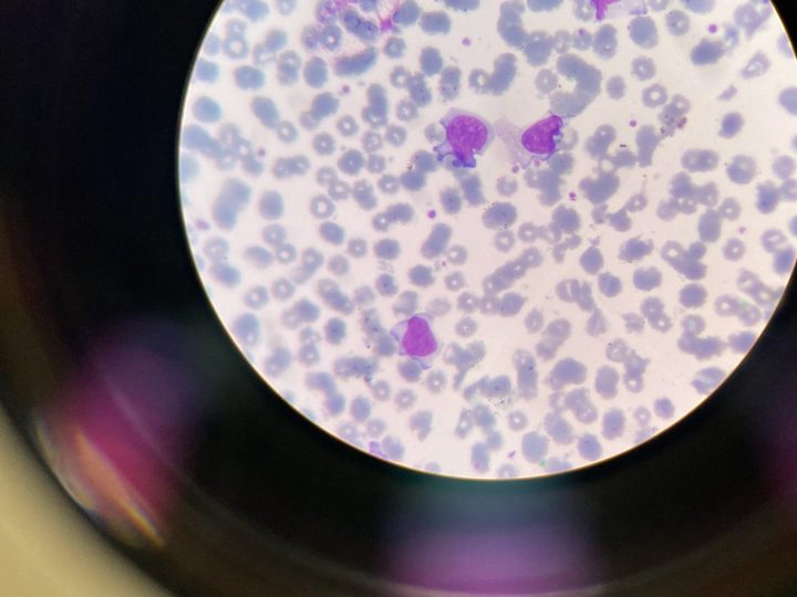 Blood smear: several atypical mononuclear cells and cell shadows