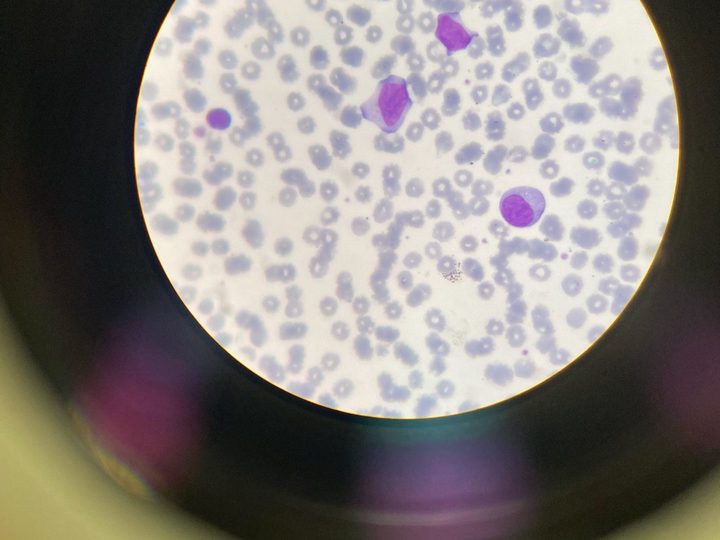 Blood smear: broad-cytoplasm reactive lymphocyte and small lymphocyte