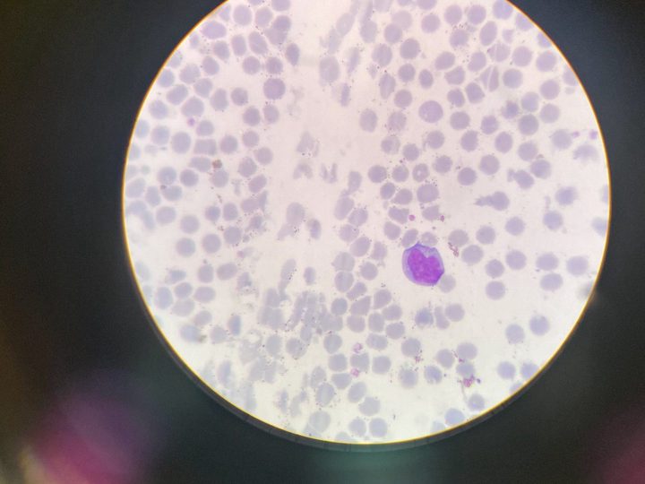 Blood smear: large reactive lymphocyte with a scalloped edge